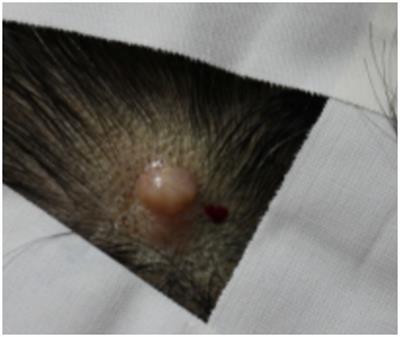 Case report: Unusual breast cancer metastasis manifesting as a scalp lesion in a patient with invasive lobular carcinoma